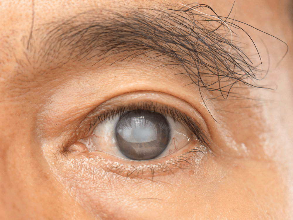 Close-up de olho com catarata avançada e opacidade no cristalino, ilustrando uma condição que pode anteceder a cirurgia ocular.